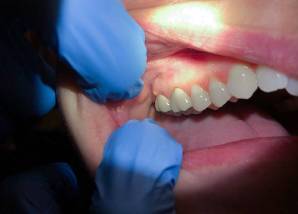 Best Emergency Denture Repair in Sherwood, OH